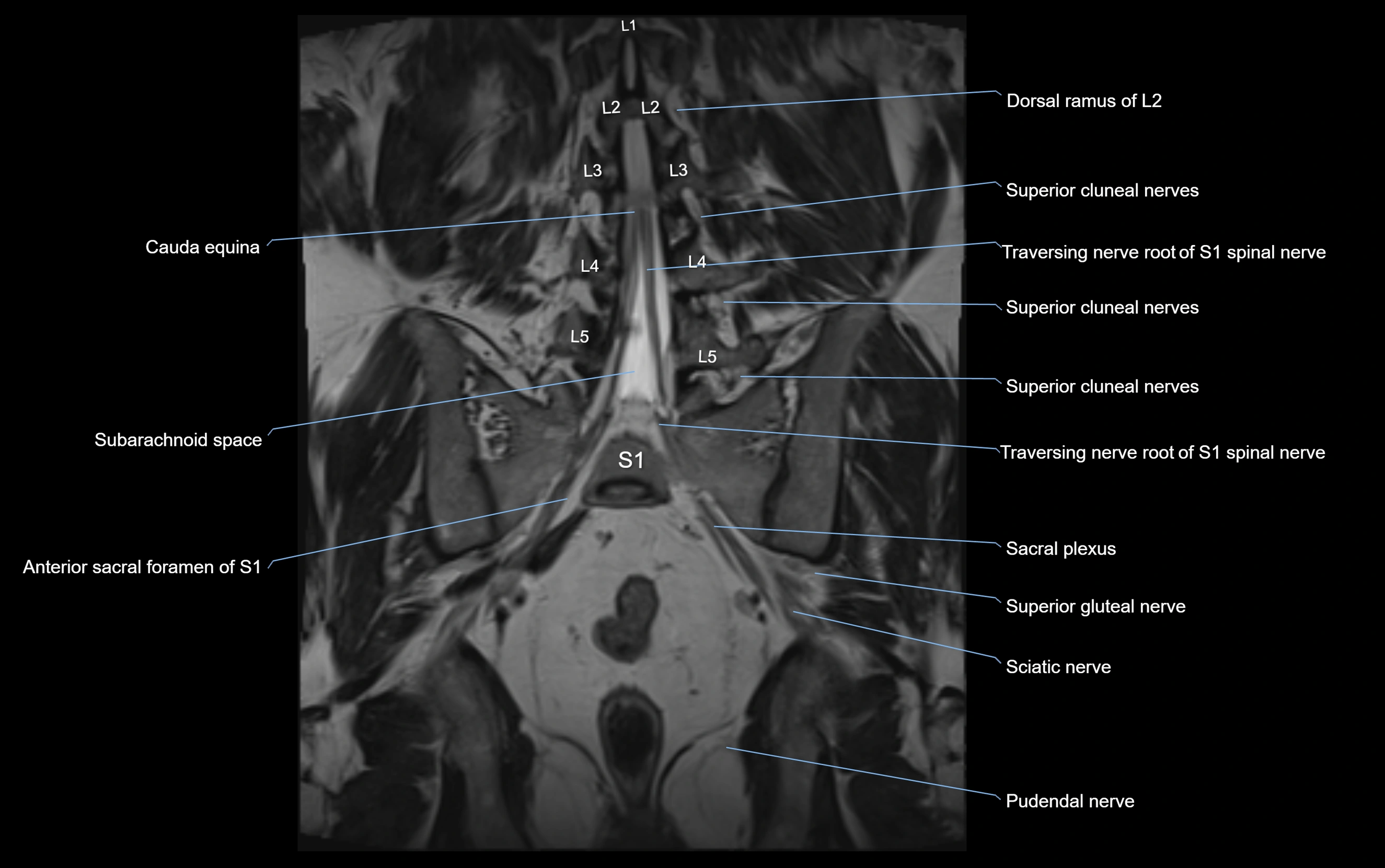 MR lumbosacral plexus cross sectional anatomy 3T  radiology  image-img-09001-00046.webp